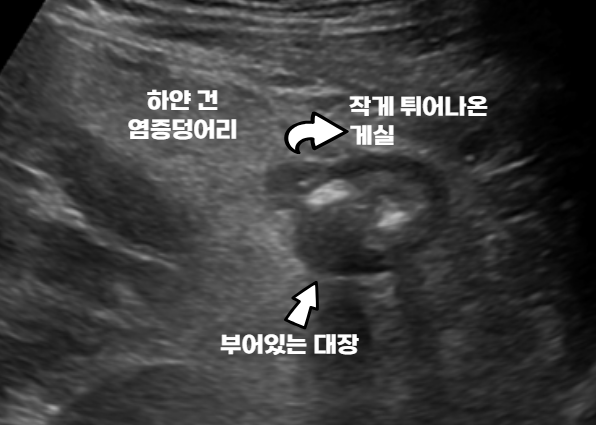 부은 대장과 돌출된 게실, 주변 염증 부위를 화살표로 표시한 복부초음파 영상