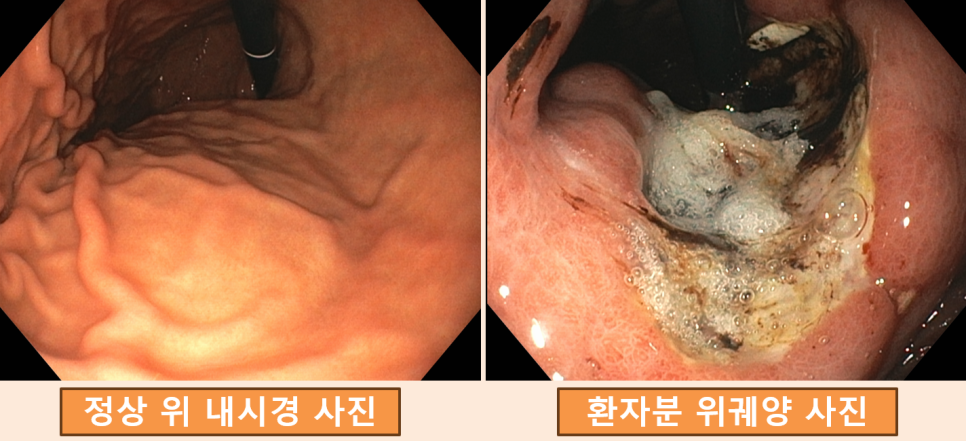 일반적인 위 점막과 넓은 궤양이 있는 환자의 위 점막을 나란히 보여주는 내시경 비교 사진