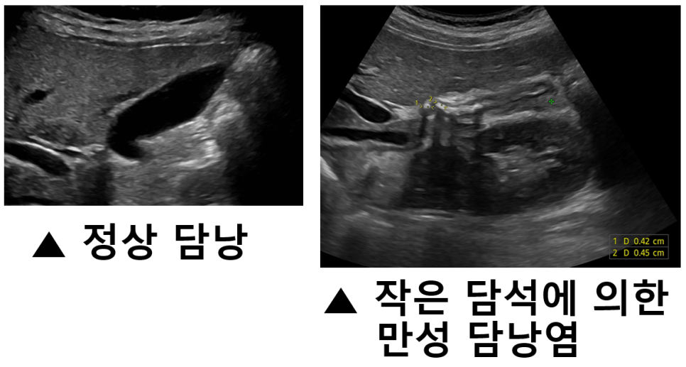 정상 담낭 예시와 작은 담석이 있는 담낭 초음파를 나란히 비교한 이미지