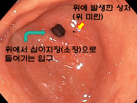 위미란의 위치와 십이지장 입구를 화살표로 표시한 내시경 영상
