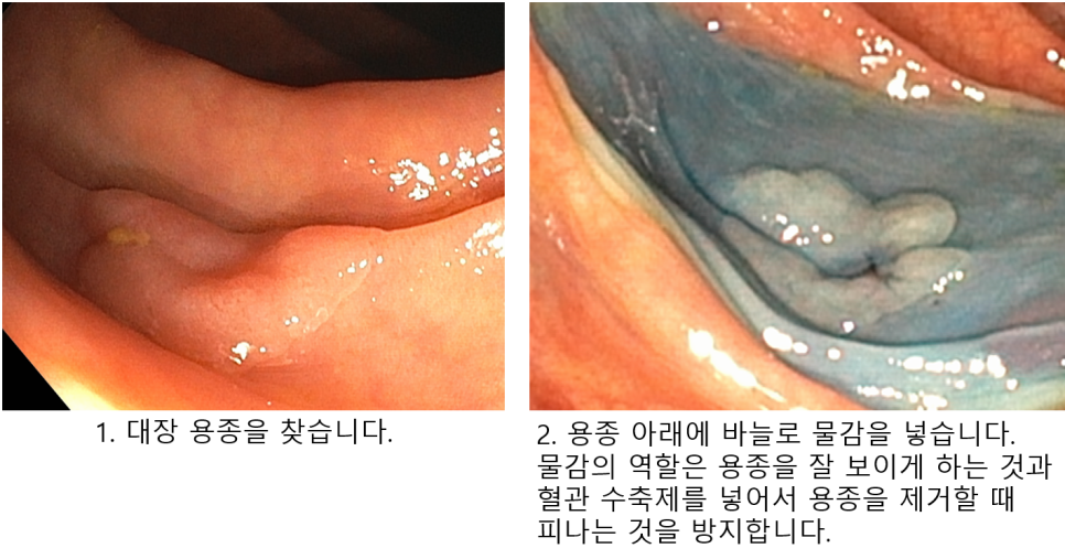 점막하 주입과 용종 절제 준비 과정을 보여주는 내시경 사진