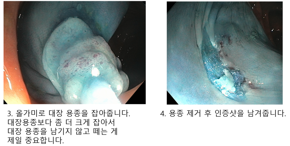 올가미 절제와 절제 후 점막 상태를 보여주는 내시경 사진