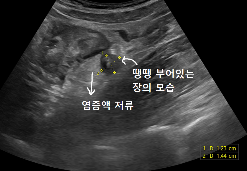 오른쪽 복부의 부어 있는 장과 주변 액체 저류를 표시한 초음파 영상
