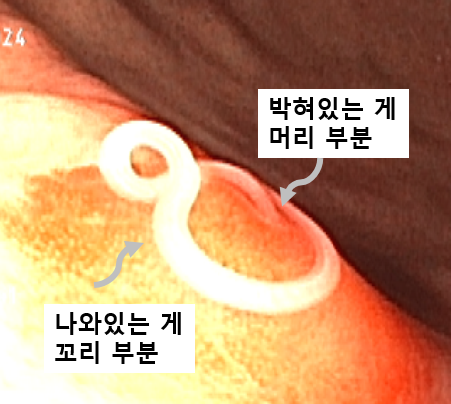 위 점막에 머리 부분이 박혀 있고 몸통이 바깥으로 나온 고래회충 유충의 내시경 영상