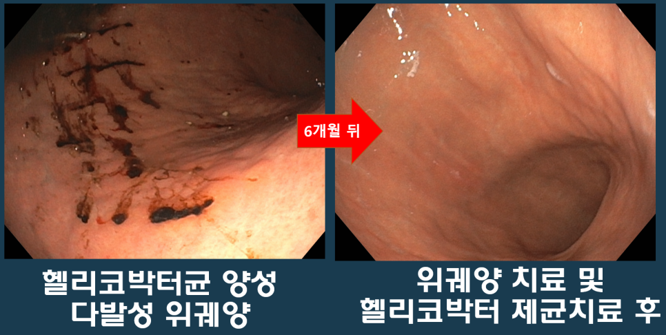 다른 위 부위의 궤양성 변화와 6개월 뒤 점막을 비교한 내시경 사진