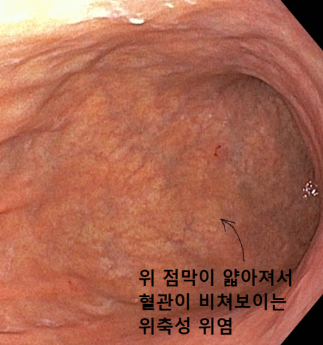 위 점막의 혈관이 비쳐 보이는 위축성 변화가 표시된 내시경 사진