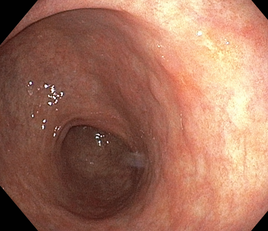 조직검사 전 위 점막 병변을 넓게 촬영한 내시경 사진
